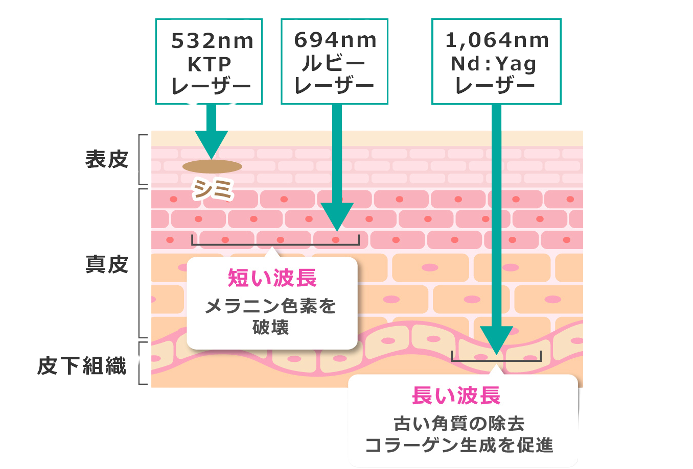 Discovery PICO 3種類のレーザー