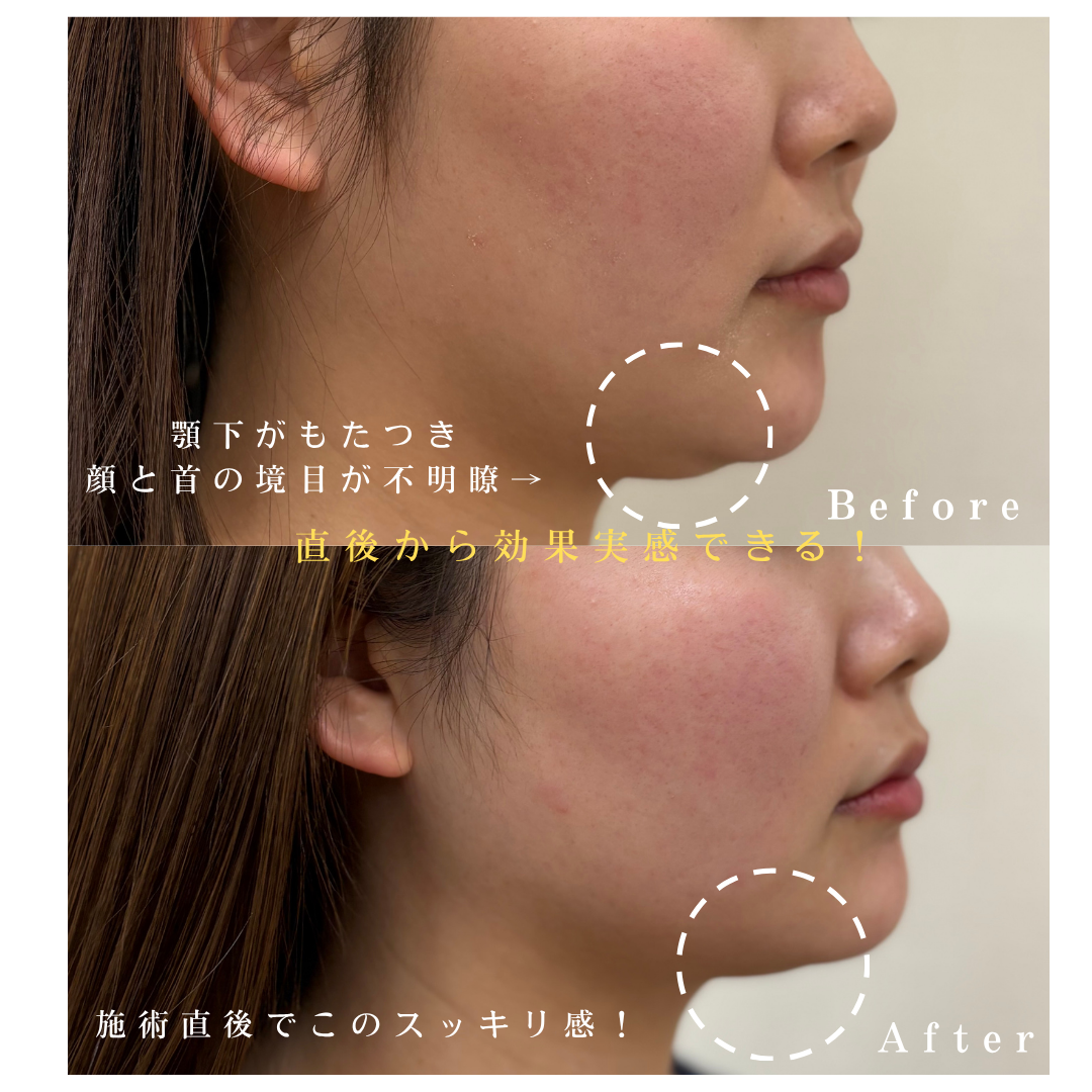 ハイプロ-Vの症例